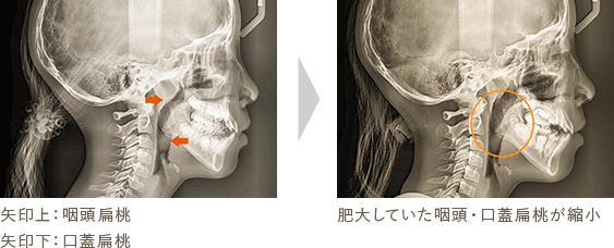 Case1 矢印上：咽頭扁桃 矢印下：口蓋扁桃 肥大していた咽頭・口蓋扁桃が縮小