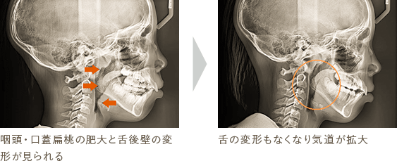 咽頭・口蓋扁桃の肥大と舌後壁の変形が見られる 舌の変形もなくなり気道が拡大