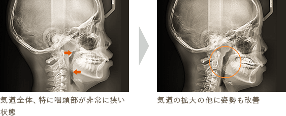 気道全体、特に咽頭部が非常に狭い状態 気道の拡大の他に姿勢も改善
