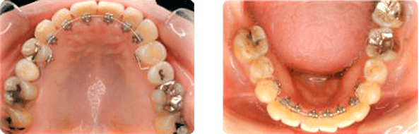 前歯の部分矯正