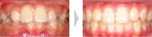治療例 - 全ての乳歯が永久歯に交換直後