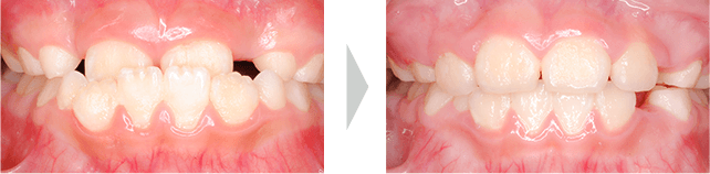 治療例 - 乳歯から永久歯に交換中