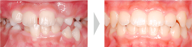 治療例 - 全ての乳歯が永久歯に交換直後