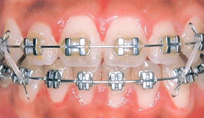 メタルブラケット