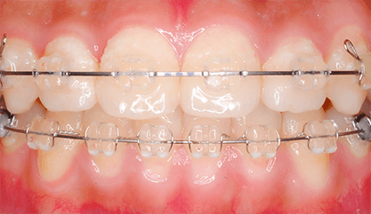 半透明な樹脂ブラケット