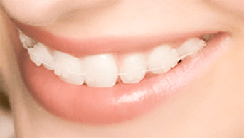 歯の色に馴染むワイヤーと併せることで表側でもほとんど目立たずに治療が可能