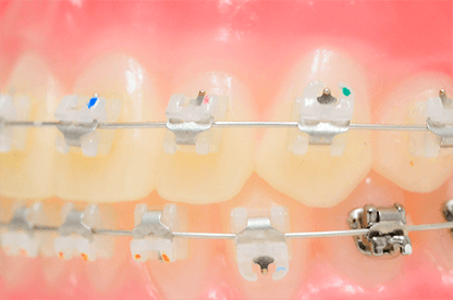 ローフリクションシステムを併用することで、個々の歯にかかる負担が少なくて済む