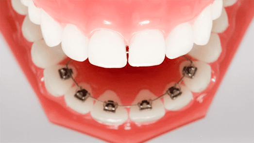 裏側の矯正治療のイメージ