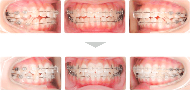 治療例 - 使用開始〜3ヶ月