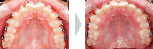 治療例① - 拡大開始〜3ヶ月