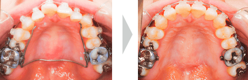 治療例② - 拡大開始〜3ヶ月