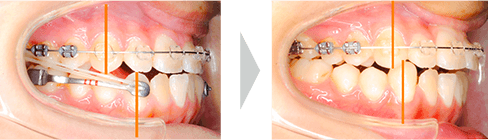 治療例② - 下顎側方歯の後方移動開始時〜3ヶ月