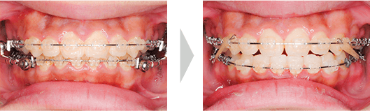 治療例① - 使用開始〜使用終了