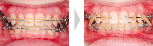 治療例② - 使用開始〜使用終了