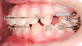 治療例① - 歯の後方移動に
