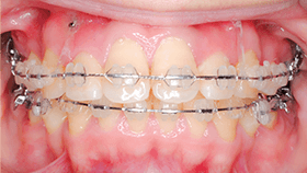 治療例② - 前歯の圧下に