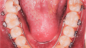 治療例③ - 倒れた奥歯を起こす時に