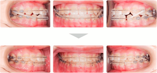 治療例 - ゴムメタルワイヤーによる治療開始時〜4ヶ月